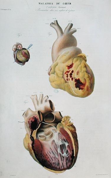 Plaat met hartziekten. Spontane scheuring van het hart van een 86-jarige vrouw (fig. 1) en pericarditis bij een zes dagen oude baby (fig. 2), uit 