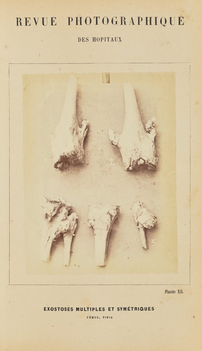 Meerdere symmetrische exostosen, femur, tibia door Arthur de Montmeja