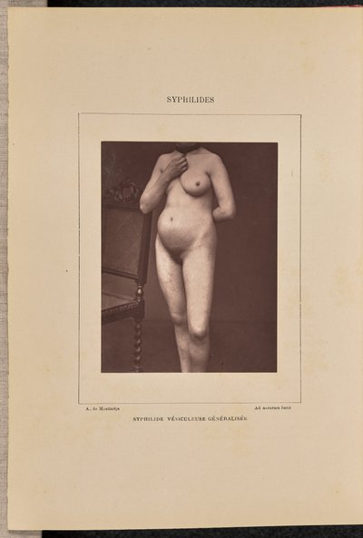 Gegeneraliseerde vesiculaire syfilis door Arthur de Montmeja
