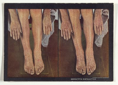 Dermatitis Exfoliativa door Dr. Selden I. Rainforth