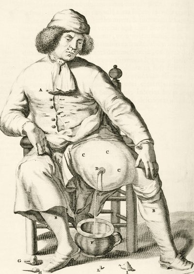 Aftappen van vocht uit een abces, uit Exercitationes Practicae circa Medendi Methodum door Frederik Dekkers, 1694 door Dutch School
