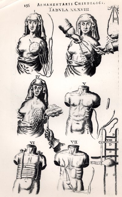 Operatie voor borstkanker, uit Armamentarii Chirurgici door Johannes Schultes (1595-1645) gepubliceerd in Amsterdam, 1672 door Dutch School