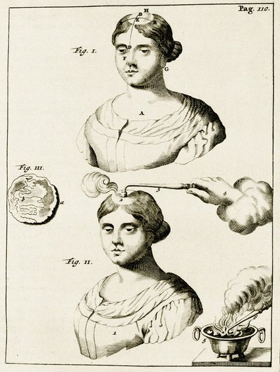 Behandeling van een epilepsiepatiënt, uit Exercitationes Practicae circa Medendi Methodum door Frederik Dekkers, 1694 door Dutch School