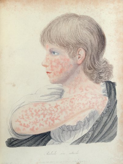 Duitse mazelen, illustratie voor een boek door Robert Willan (1757-1812), 1808 (kleurgravure) door English School