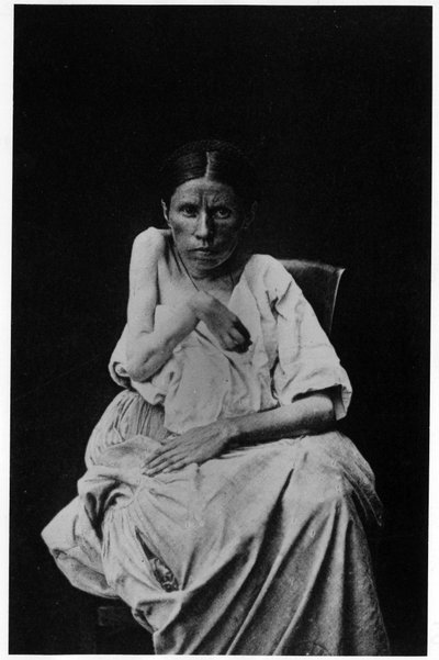 Foto van een patiënt met hemiplegische epilepsie, in "fotografische iconografie van de Salpetrière, Bourneville en P. Regnard, Parijs" door French Photographer