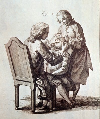 Een arts die een cataractpatiënt opereert, illustratie uit de Medische Encyclopedie van Denis Diderot en Jean le Rond d