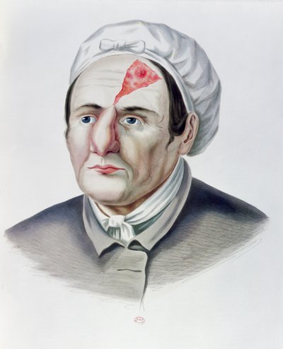 Na een huidtransplantatie-operatie, uit Selecta Praxis Medico-Chirurgica door Alexander Auvert, Parijs, 1856 door French School
