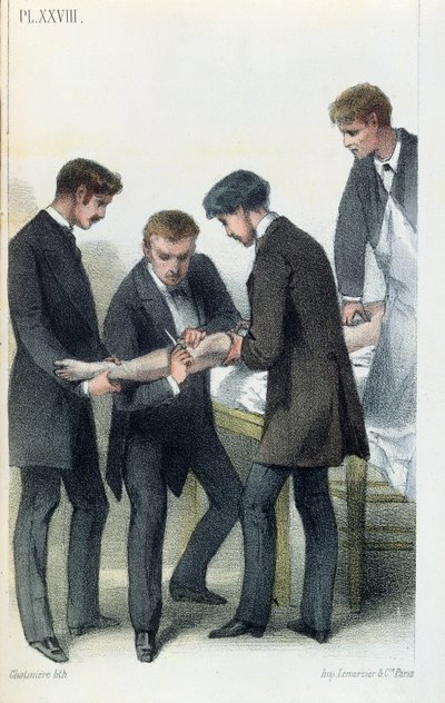 Amputatie van een arm, uit een medisch handboek door Jean-Baptiste-Leon Dubreuil, ca. 1850-60 door French School