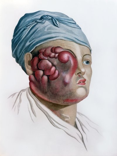 Kankerachtige scrofula, uit Description des Maladies de la Peau door Baron Jean Louis Alibert (1768-1837) Parijs, 1806 door French School