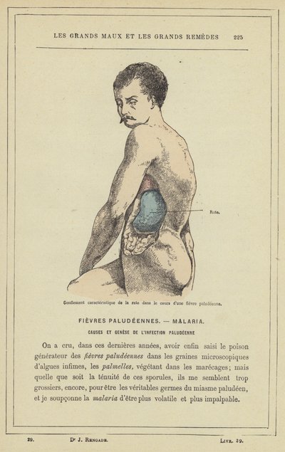 Kenmerkende zwelling van de milt tijdens een malaria-koorts door French School