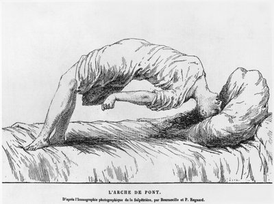 Hysterie en slaapwandelen, uit Les Maladies Epidemiques de l