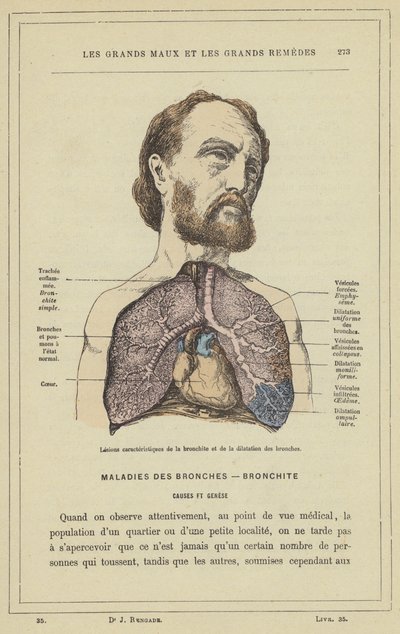 Kenmerkende laesies van bronchitis en bronchiale dilatatie door French School