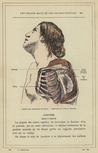 Luxatie onder het coracoïde van de schouder, verplaatsing van de kop van de humerus door French School