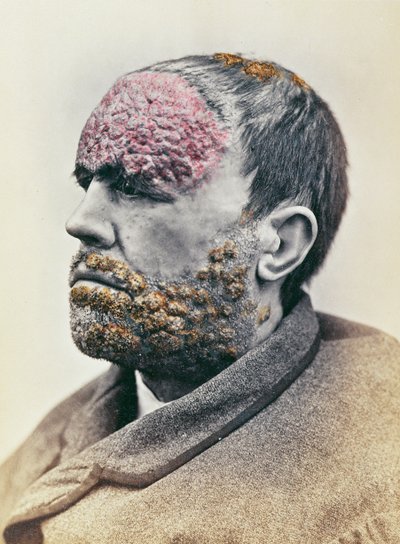 Man die lijdt aan syfilis, van een foto genomen voor de Clinique Photographique de l