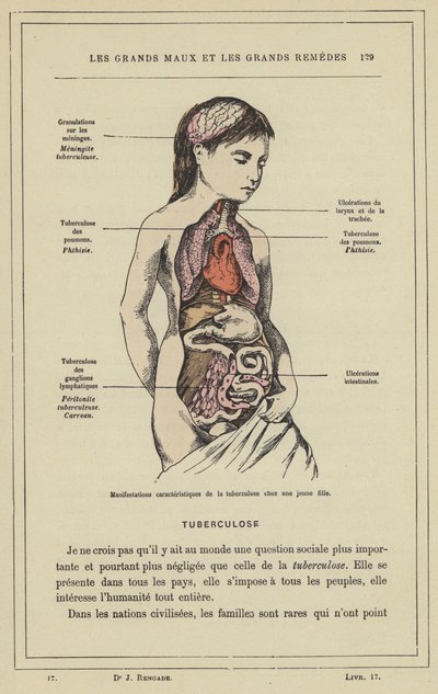 Kenmerkende manifestaties van tuberculose bij een jong meisje door French School