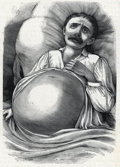 Patiënt met gevorderde levercirrose (gravure) 1888 door French School
