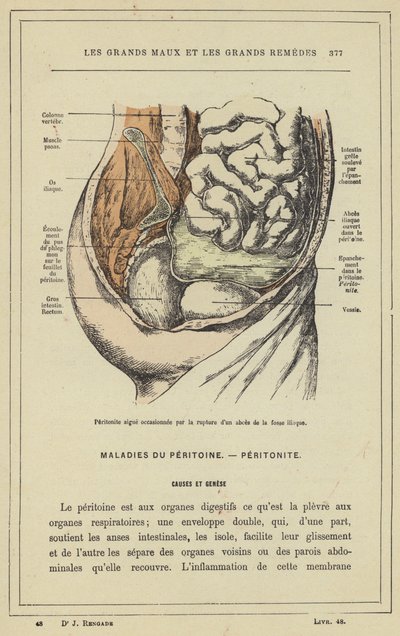 Acute peritonitis veroorzaakt door een gescheurd abces in de iliacale fossa door French School