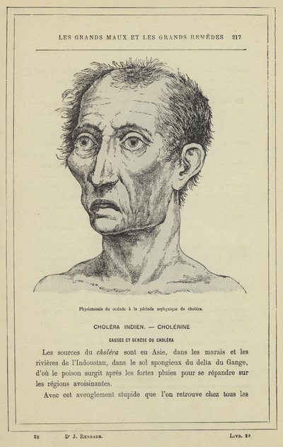 Gezicht van de patiënt in de verstikkingsfase van cholera door French School