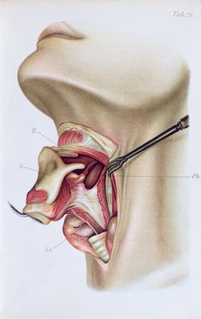 Plaat uit Atlas en Epitome of Operative Surgery door Dr. Otto Zuckerkandl (1861-1921) 1910 door French School
