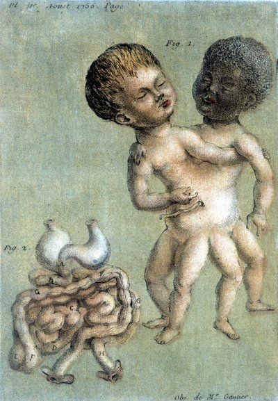 Medische plaat die Siamese broers voorstelt: een witte en een zwarte. illustratie door Toussaint (1756) in Periodic Observations sur la physique, l