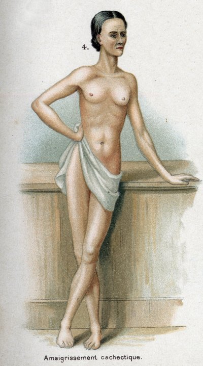 Portret van een vrouw met cachectisch gewichtsverlies (print) door French School