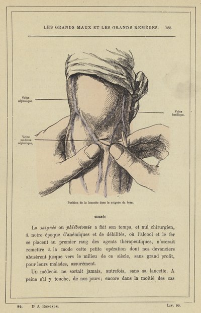 Positie van de lancet in de aderlating van de arm door French School