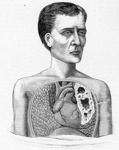 Voorstelling van een persoon met grotten, complicatie van tuberculose (gravure) door French School