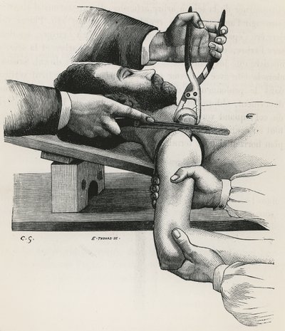 Resectie van de schouder (uit 