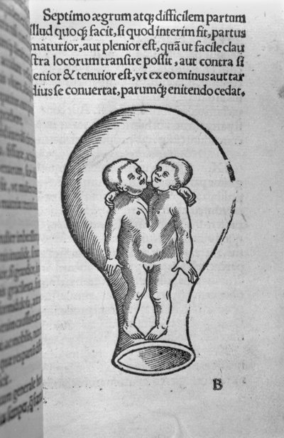 Siamese kinderen, illustratie uit het zogenaamde Rhodion-manuscript door French School