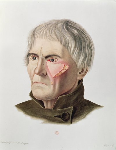 Huidtransplantatie operatie, uit Selecta Praxis Medico-Chirurgica door Alexander Auvert, Parijs, 1856 door French School