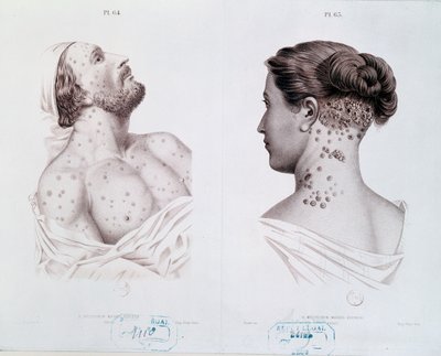 Symptomen van syfilis bij mannen en vrouwen, uit een medisch boek, c.1850-60 door French School