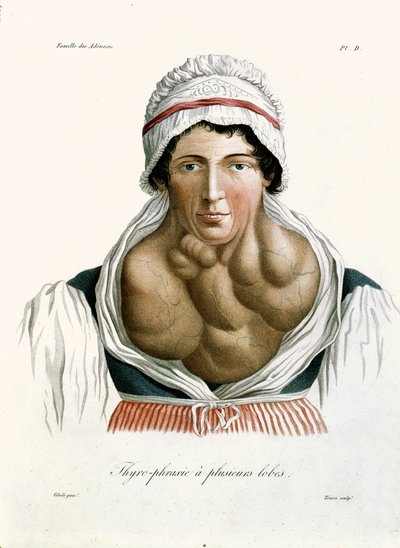 Schildklieraandoening, uit een boek van Baron Jean Louis Alibert (1768-1837) 1817 door French School