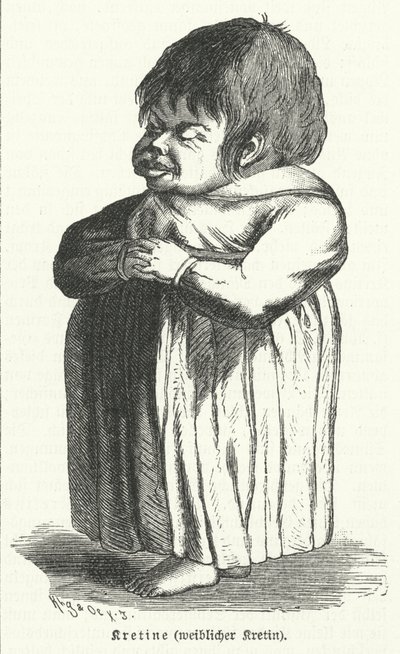 Kretin, vrouw die lijdt aan aangeboren jodiumtekortsyndroom (gravure) door German School
