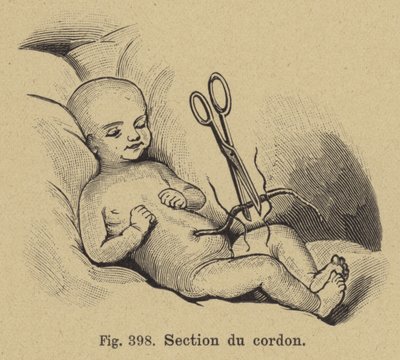 Afknippen van de navelstreng van een pasgeboren baby door German School