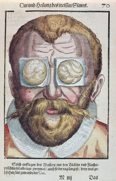 Behandeling van een oogkwaal, uit Ophthalmodouleia door Georg Bartisch, gepubliceerd in Dresden in 1583 door German School