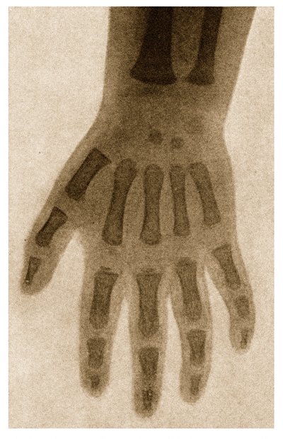 Röntgenfoto van een Kinderhand, ca. 1890 door German School