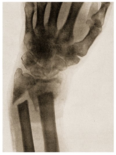 Röntgenfoto van een Gebroken Pols, ca. 1890 door German School