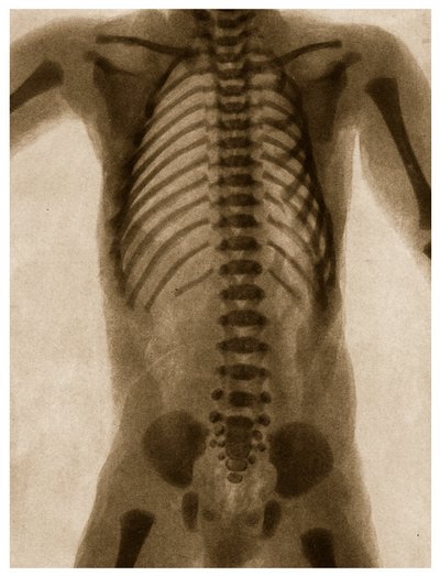 Röntgenfoto van een Menselijke Torso, ca. 1890 door German School