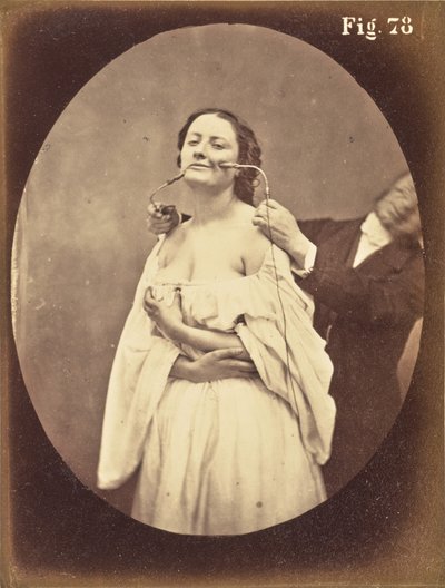 Fig. 78 door Guillaume Benjamin Duchenne