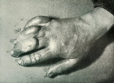 Dr. Atkinsons Bevroren Hand, 5 juli 1911, 1913 door Herbert Ponting