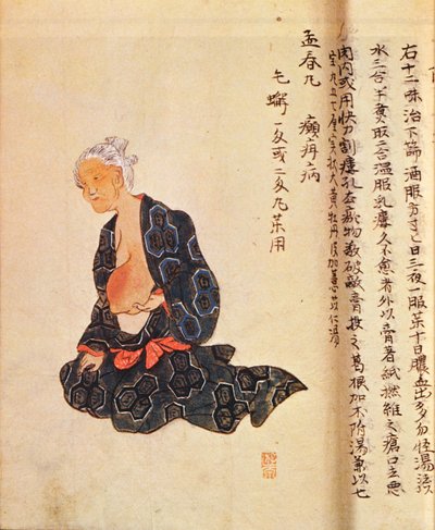 De eerste chirurgische behandeling van borstkanker uitgevoerd onder algemene verdoving door Seishu Hanaoka in 1804 door Japanese School