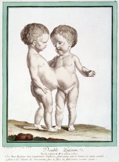 Siamese kinderen - in "Les déviations de la nature" door Régnault door Jean Baptiste Regnault