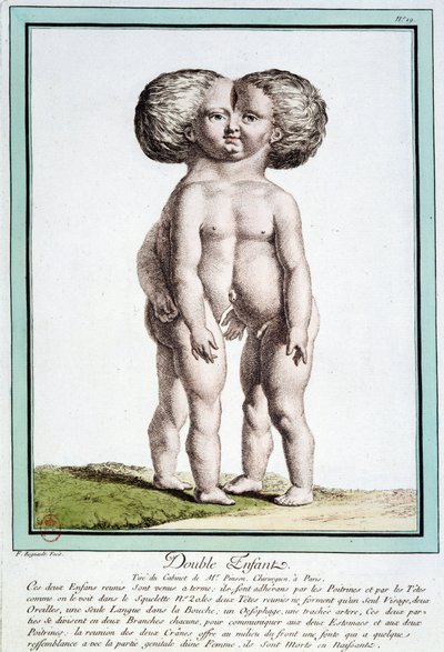 Siamese kinderen - in "Les déviations de la nature" door Régnault door Jean Baptiste Regnault