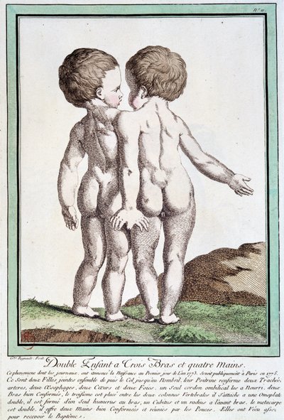 Siamese kinderen - in 