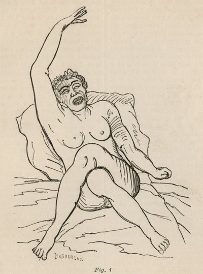 Hysterische epilepsie, aanval, vervormingen, fig. 1 uit 