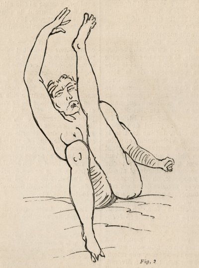 Hysterische epilepsie, aanval, vervormingen, fig. 2 uit 
