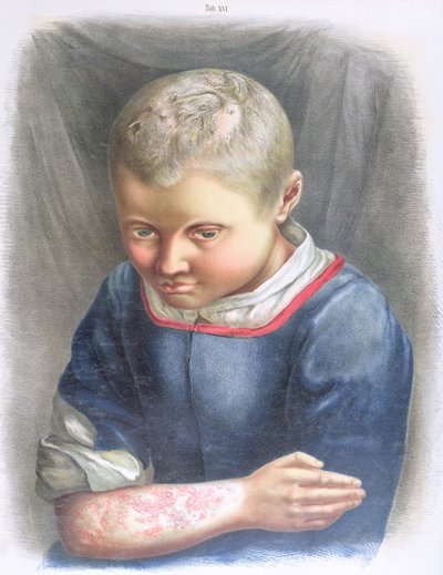Favus, uit een boek door Daniel Cornelius Danielssen, 1892 door Norwegian School