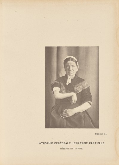 Cerebrale atrofie: Partiële epilepsie Hemiplegie rechts door Paul Marie Léon Regnard