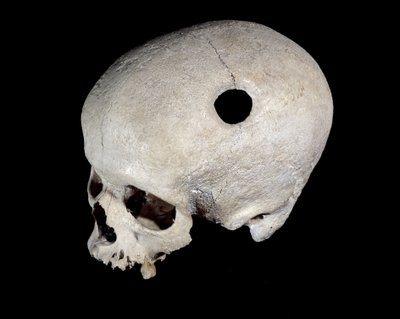 Prehistorische schedel met trepanatiespoor, Museum van Nationale Oudheden door Prehistoric Prehistoric