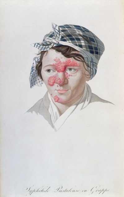 Syfilitische clusterpuisten, uit een boek van Baron Jean Louis Alibert, 1838 door Salvadore Tresca